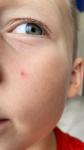 Красное пятно на щеке у ребенка 8 лет фото 1