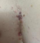 Сыпь угри раздражение высыпания между грудьми, 13 лет фото 1