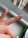 Красный бугорок на пальце, не болит, но причиняет физический дискомфорт фото 5