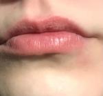 Сыпь на губах, белое пятно на нижней губе фото 1