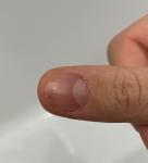 Чёрная точка на ногте, болит палец фото 1