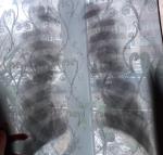 Расшифровка рентгеновского снимка, подозрение на пневмонию фото 1