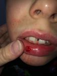 Ребёнок порезал губу зубом при падении фото 2