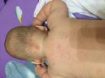 Красные пятна на спине, шее и голове у ребёнка 5 месяцев фото 3