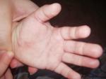 Красные пятна на ладошках у ребёнка 2 года фото 1