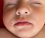 Розово-коричневые пятна вокруг рта у ребёнка фото 1