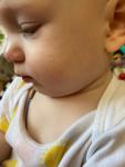 Кинбурн красные прыщики на лице у ребёнка 8 месяцев фото 2