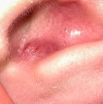 Воспаление в ушной раковине фото 1