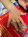 Покраснения на поверхности рук у ребенка 1 год и 11 месяцев фото 1