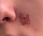 Красное пятно на лице с шелушением фото 1