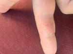 Проблема экземы или дерматита на пальцах рук фото 1