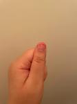 Полоска на ногте и странности на коже фото 2