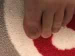 Темное Пятно на ногте Лёвой ноги фото 1