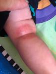 Атопический дерматит у ребёнка 4 месяца под ямками в коленях фото 1