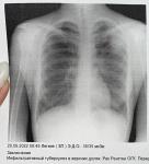 Боль в грудной клетке, туберкулез? фото 1