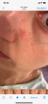 Сыпь на лице в виде белых прыщиков с покраснением фото 2