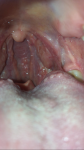 Белый налёт в горле и непроходимый кашель фото 3