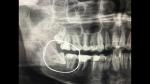 Насколько сложно удалить зуб мудрости (фото рентгена) фото 1