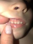 Черные точки на передних зубах фото 1