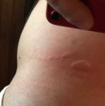 Высыпания в виде укусов комаров на талии, голенях и предплечиях фото 1