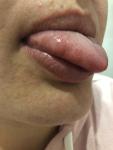 Воспаление языка, жжение фото 2