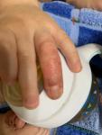 Неизвестная экзема на пальцах у ребёнка фото 2