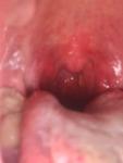 Боль в горле, увеличены миндалины фото 1