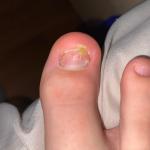 Желтое пятно на ногте с переходом на кожу фото 1