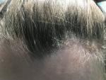 Псориаз волосистости части головы фото 4