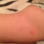 Сыпь у ребенка в виде укусов комаров фото 2