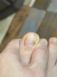 Коричневое пятно на ногте -это меланома? фото 1