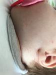 Высыпания на лице новорожденной фото 2