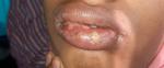 Инфекция на губах фото 1