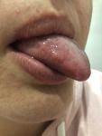 Воспаление языка, жжение фото 1
