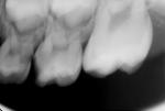Пульпит и кариес молочных зубов фото 2