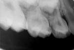 Пульпит и кариес молочных зубов фото 1