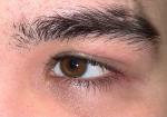Разные глаза после травмы фото 3