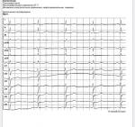 Неспецифические изменения ST-T фото 1