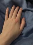 Воспаление после хруста пальца фото 1