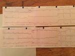 Расшифровка ЭКГ после инфаркта миокарда фото 1