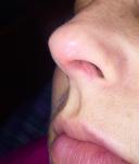 Болячка в носу и лимфоузел фото 1