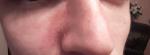 Красные пятна с двух сторон у носа, шелушение фото 1