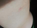 Непонятное кожное воспаление (таз, спина, стрии) фото 4