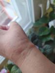 Сыпь на руках, сильный зуд фото 3
