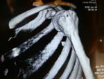 Деформация плечевой кости фото 5