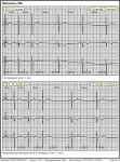 Холтеровское мониторирование, СА-блокады 2 степени фото 4