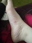 Розовые болячки на ступнях фото 1