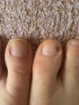Синяки на ногтях ног фото 3