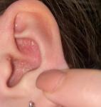 Мокнущее шелушение в ушной раковине фото 2