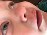Увеличивающееся покраснение над верхней губой у ребёнка 2-х лет фото 1